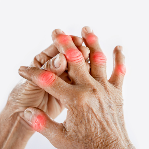 Person hält sich schmerzende Finger an der Hand